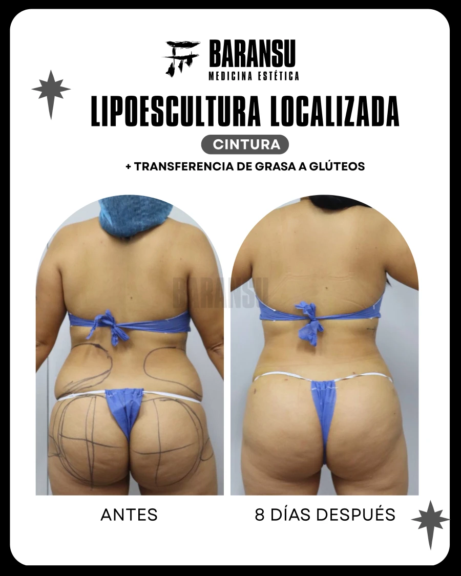 Lipoescultura Localizada (Minilipo) 24