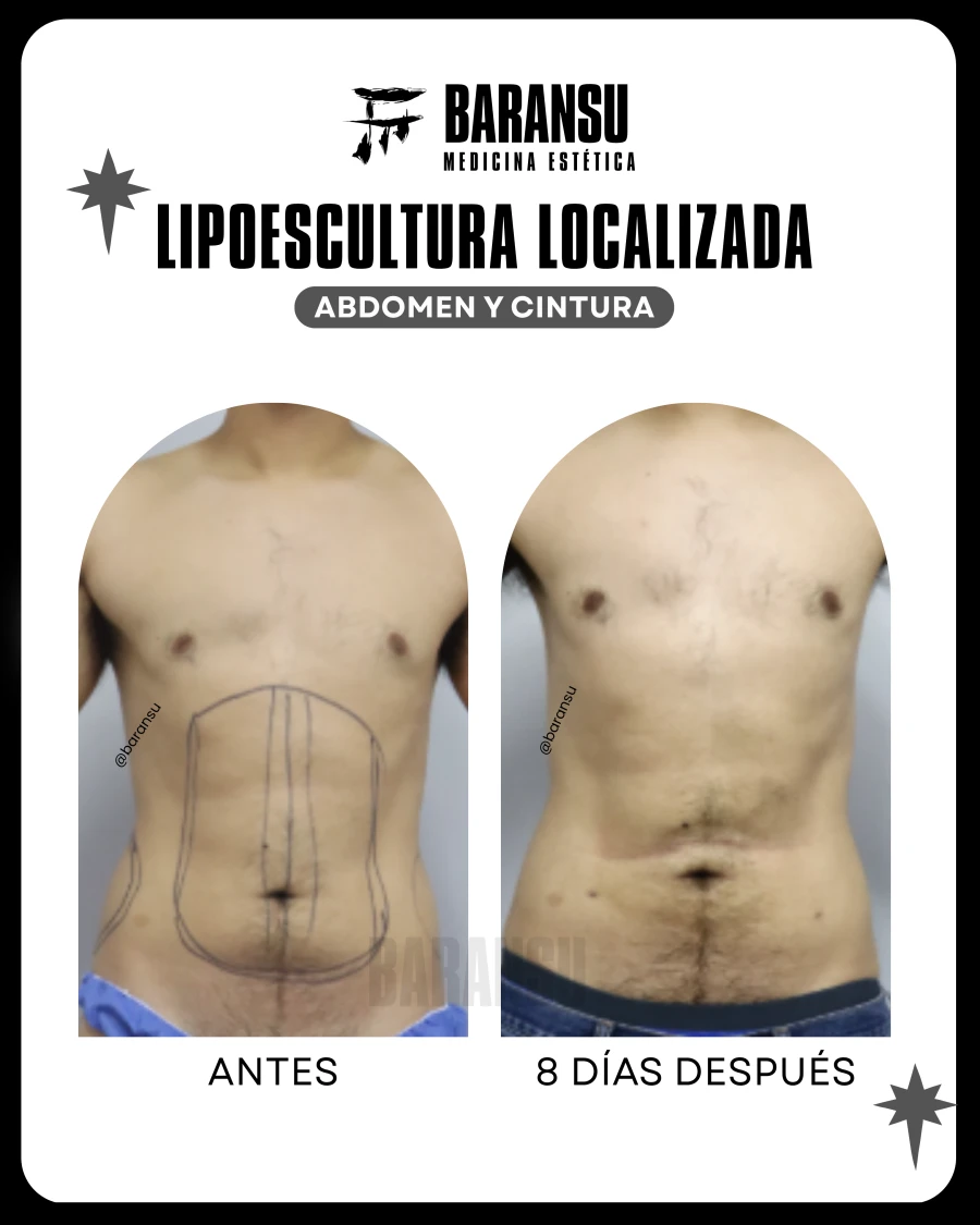 Lipoescultura Localizada (Minilipo) 36