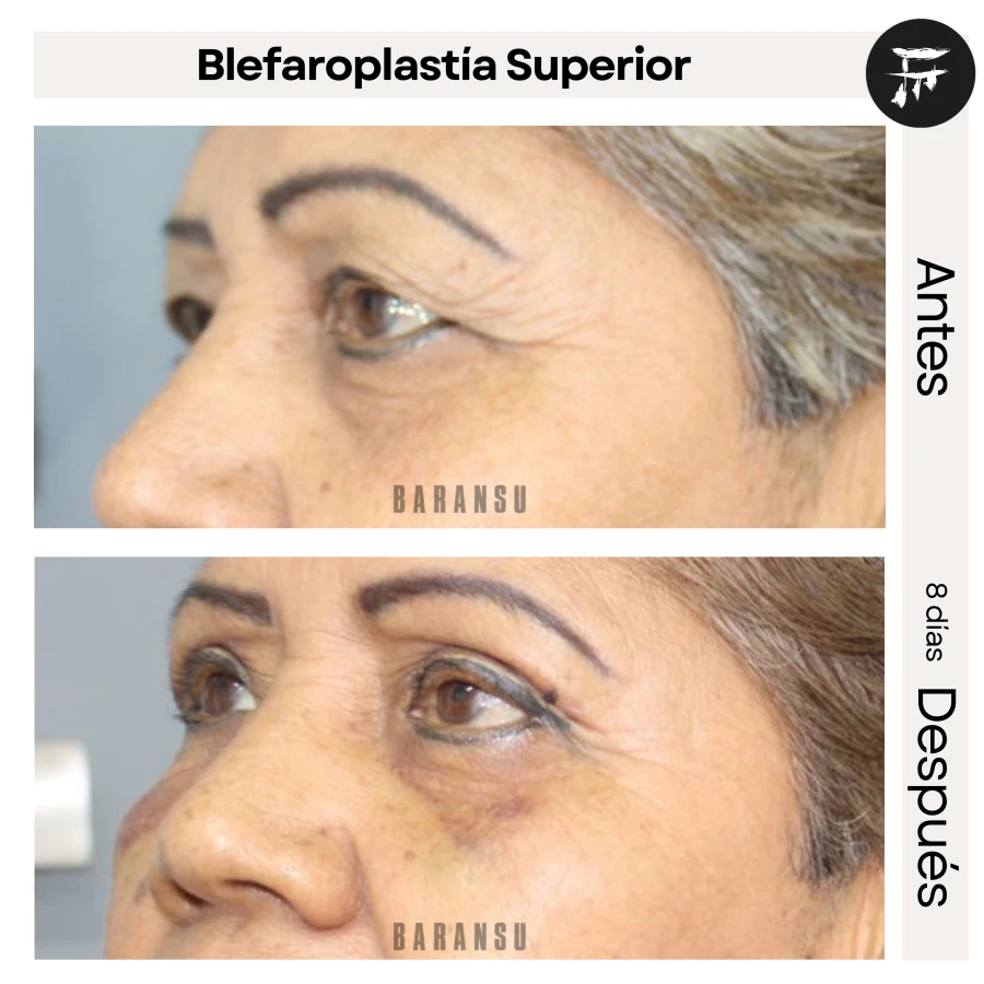 Blefaroplastía Superior 