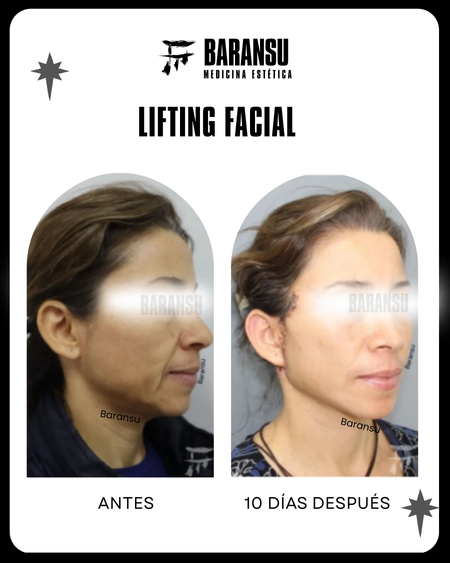 Lifting Facial 2