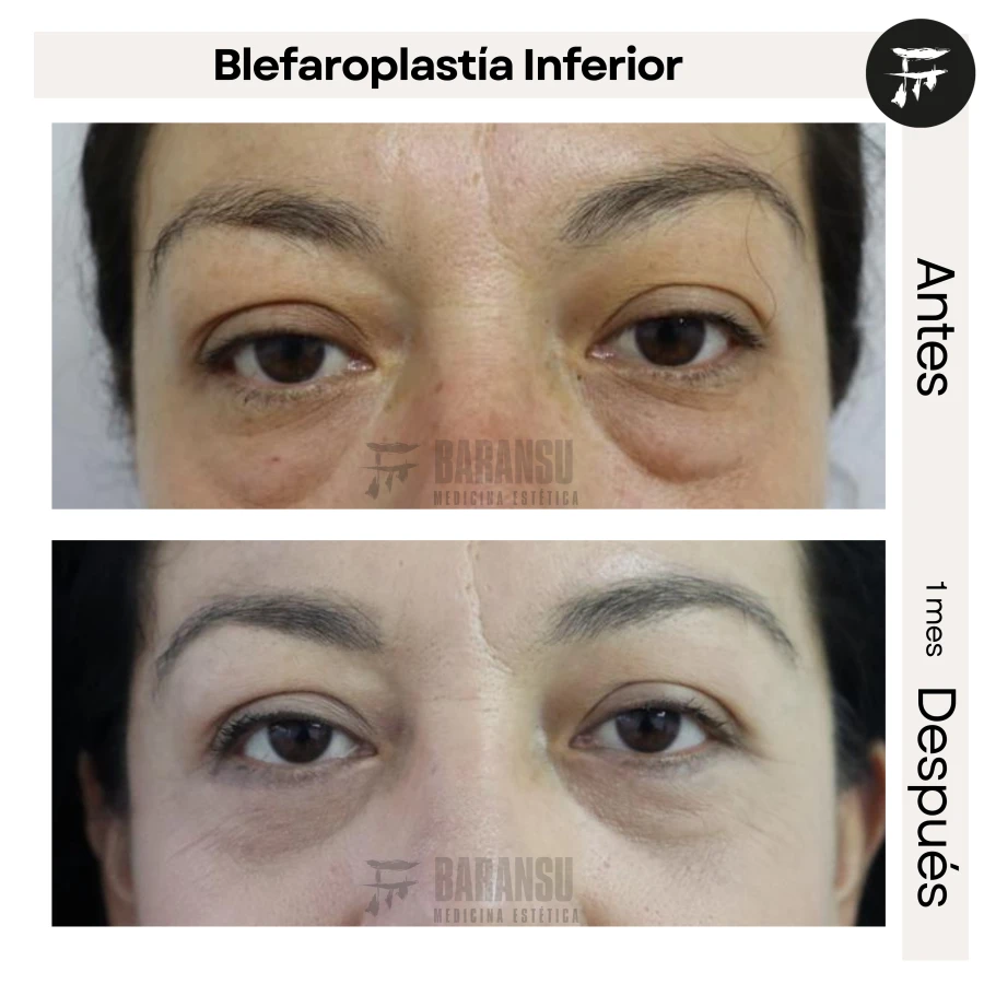 Blefaroplastía Inferior