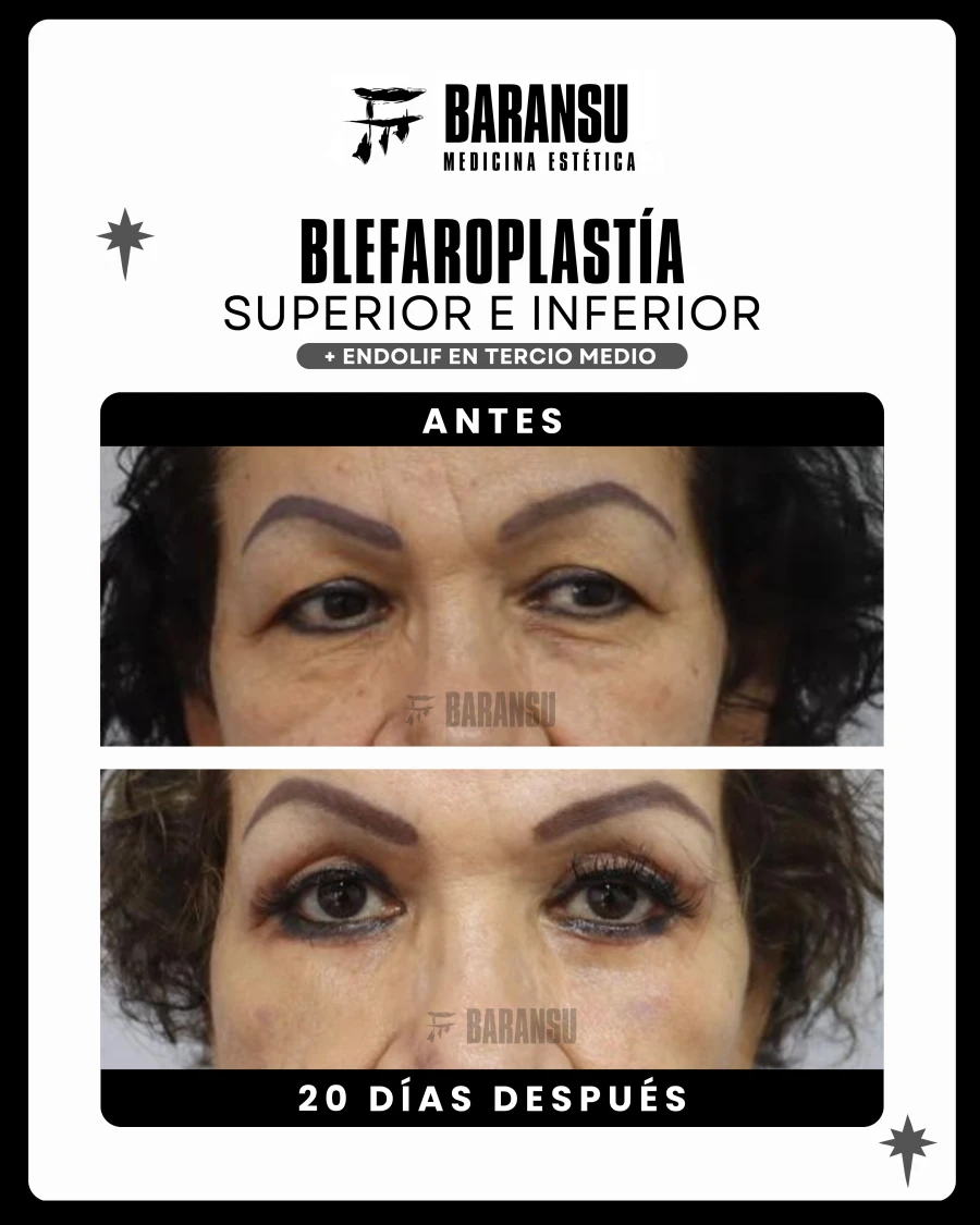 Blefaroplastía Superior e Inferior 3