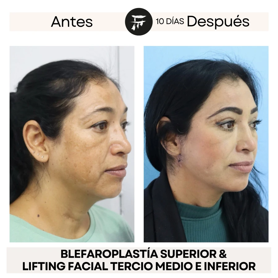 Lifting Facial +  Blefaroplastía Superior e Inferior