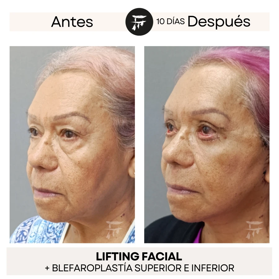 Lifting Facial + Blefaroplastía Superior e Inferior