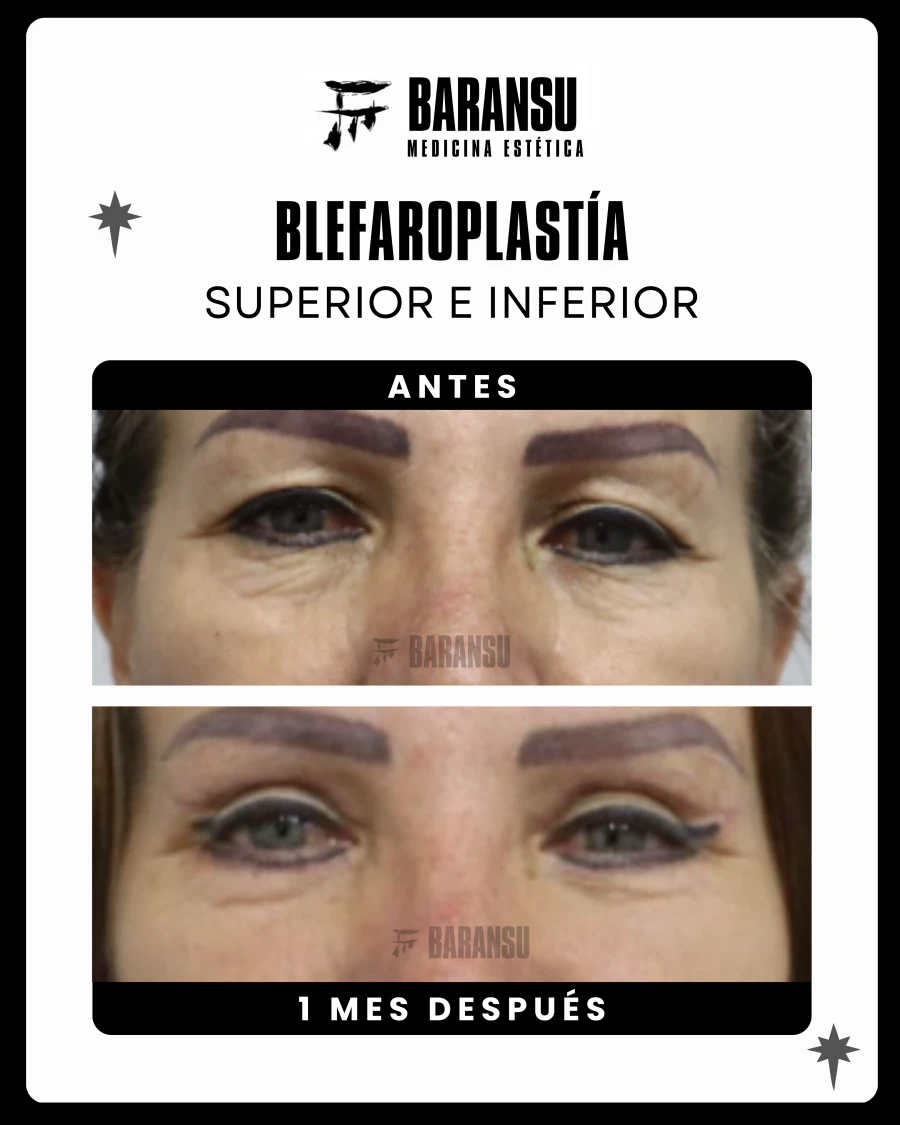 Blefaroplastía Superior e Inferior 5
