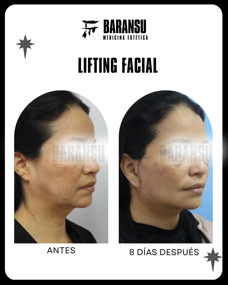 Lifting Facial 4