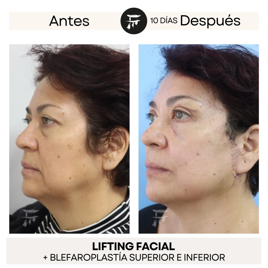 Lifting Facial + Blefaroplastía Superior e Inferior