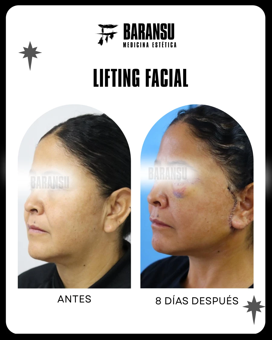 Lifting Facial 22