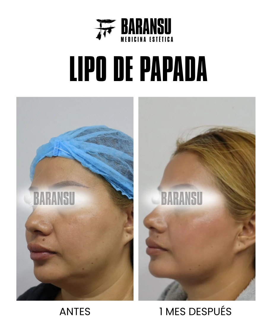 Lipo de Papada 17