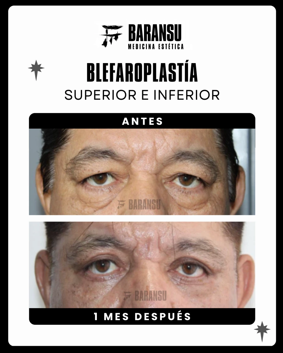 Blefaroplastía Superior e Inferior 