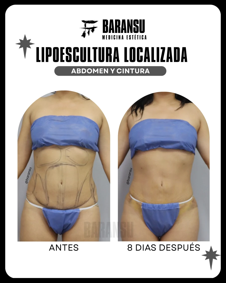 Lipoescultura Localizada (Minilipo) 46