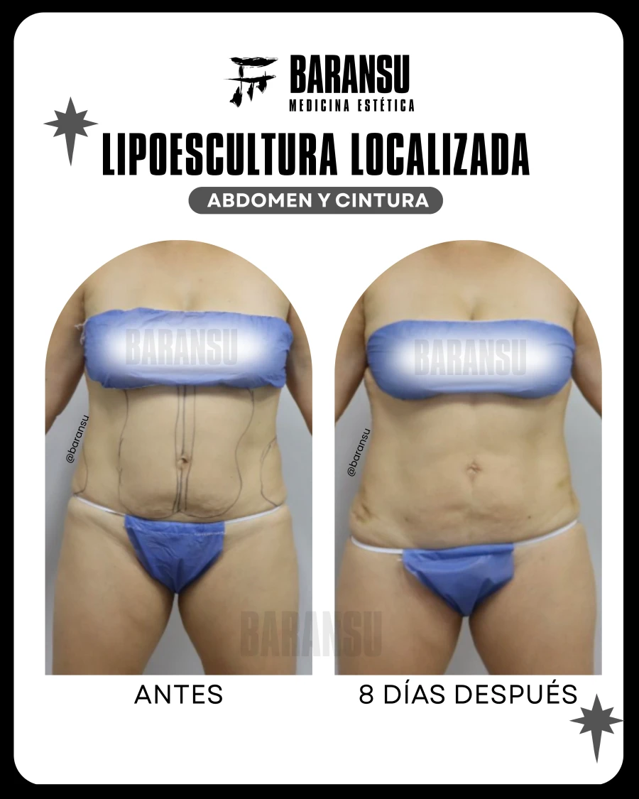 Lipoescultura Localizada (Minilipo) 35