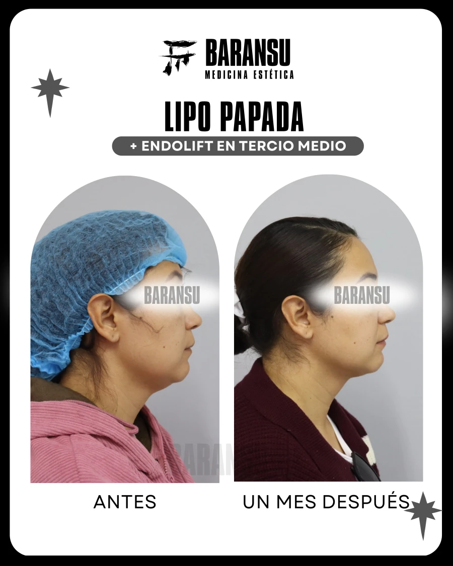Lipo de Papada + Endolift 20