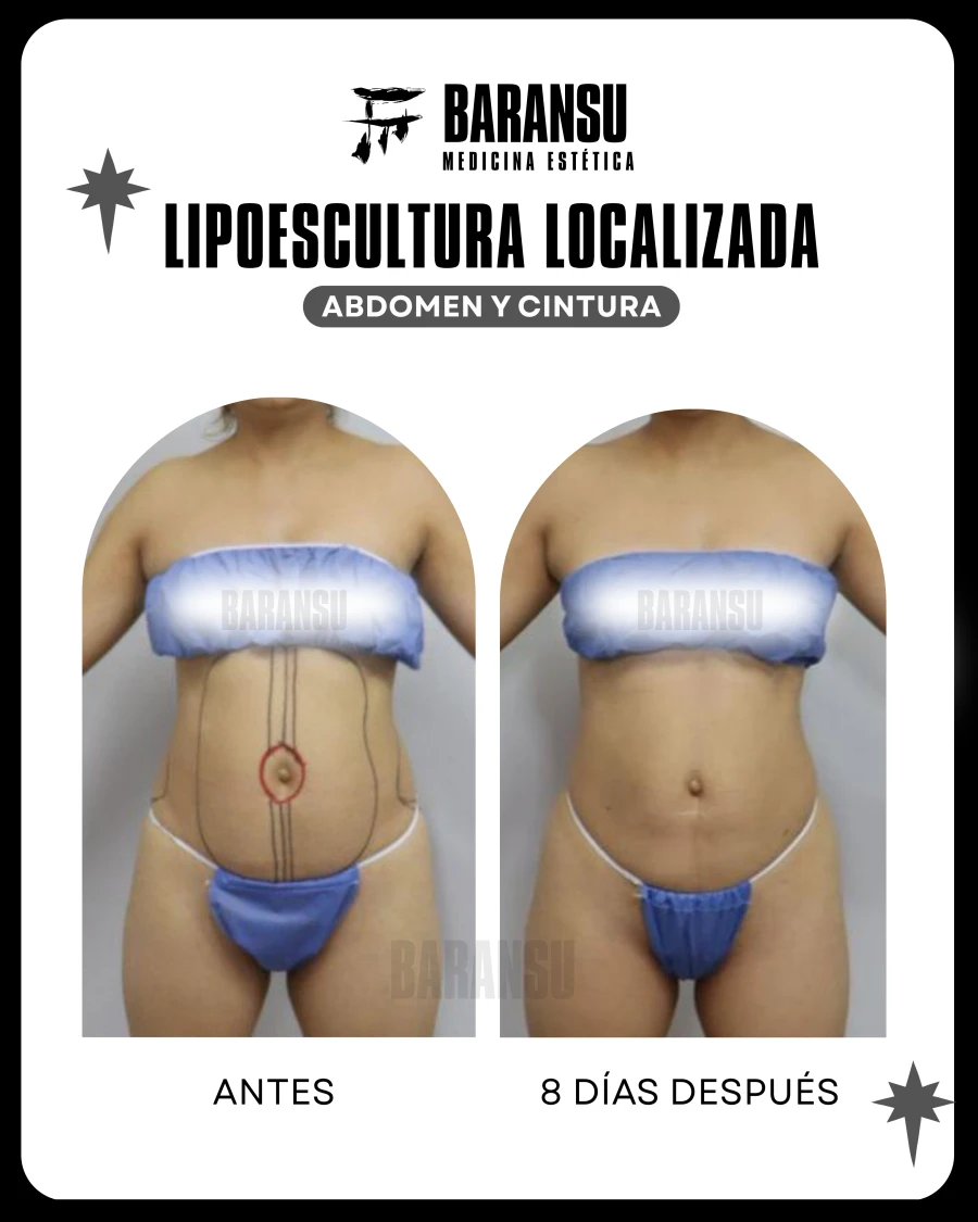 Lipoescultura Localizada (Minilipo) 32