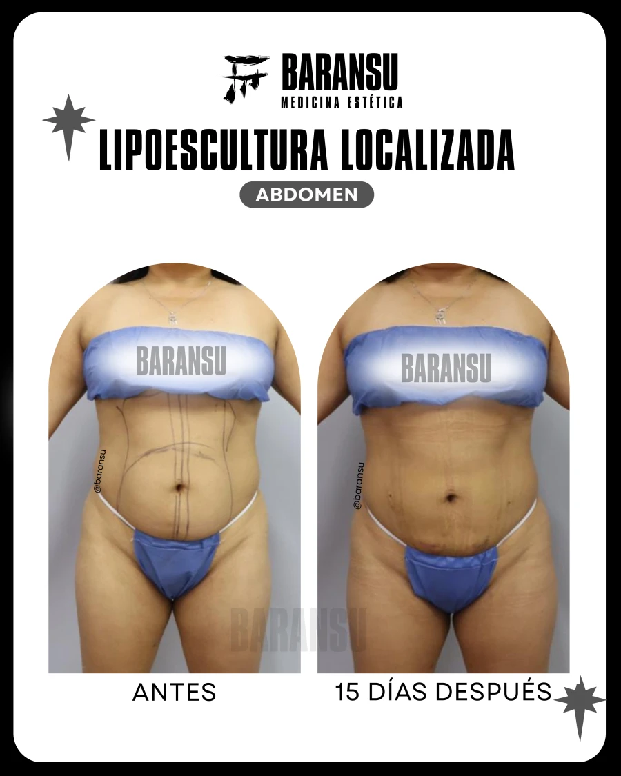 Lipoescultura Localizada (Minilipo) 41
