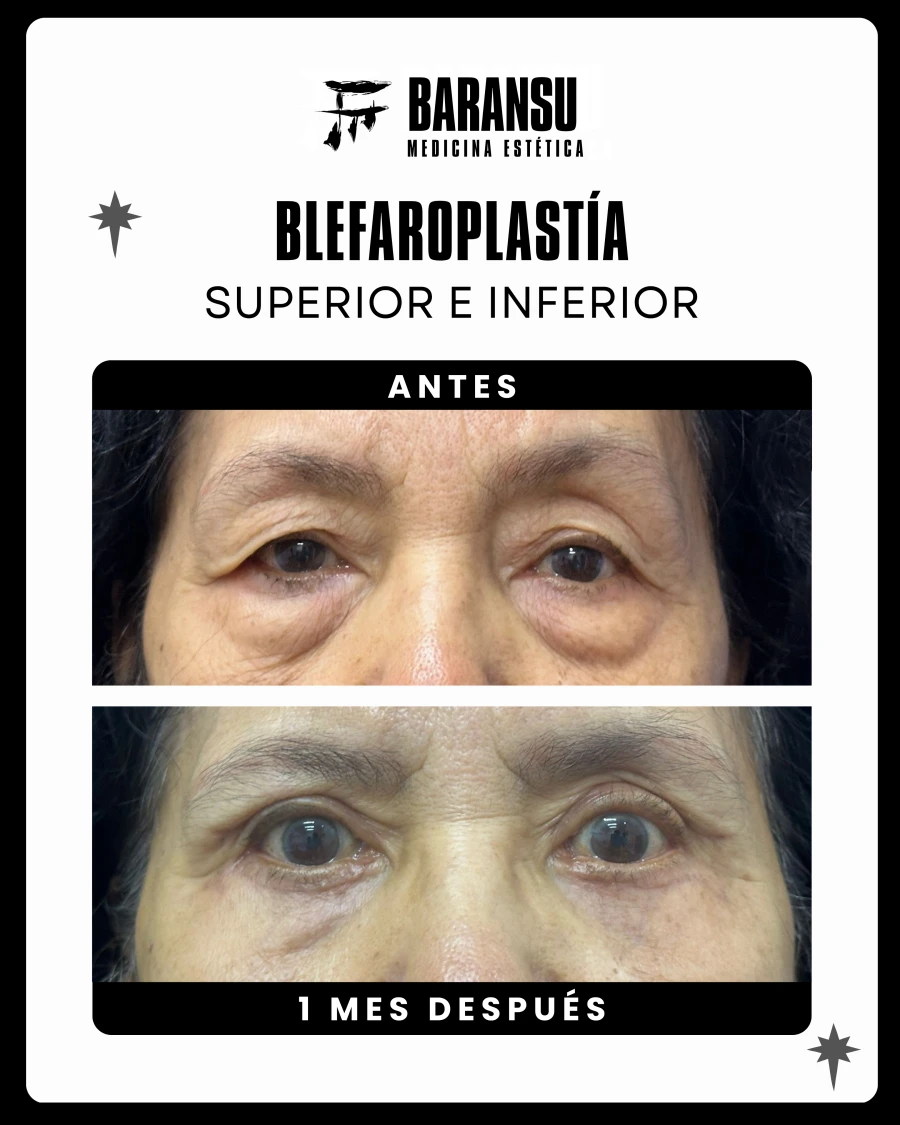 Blefaroplastía Superior e Inferior