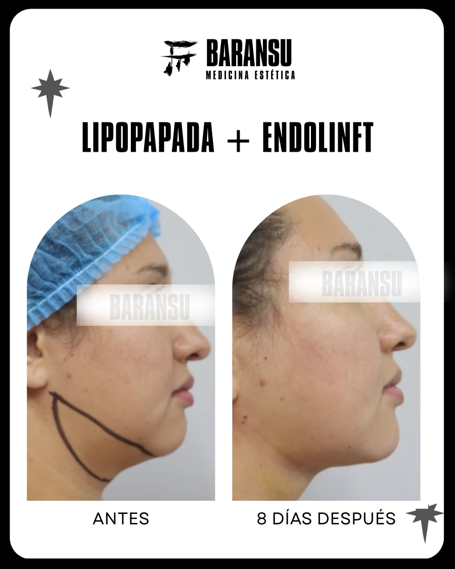 Lipo de Papada 18
