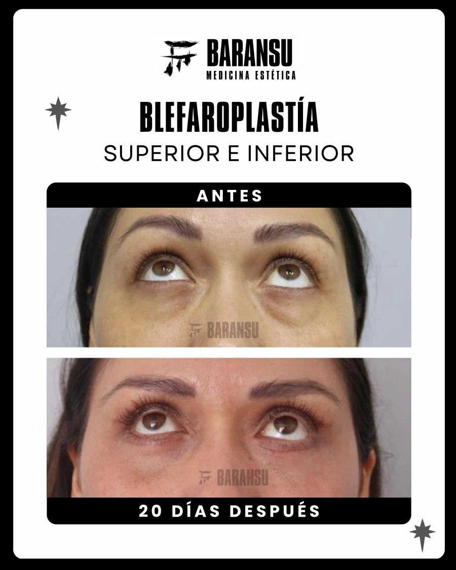 Blefaroplastía Superior e Inferior