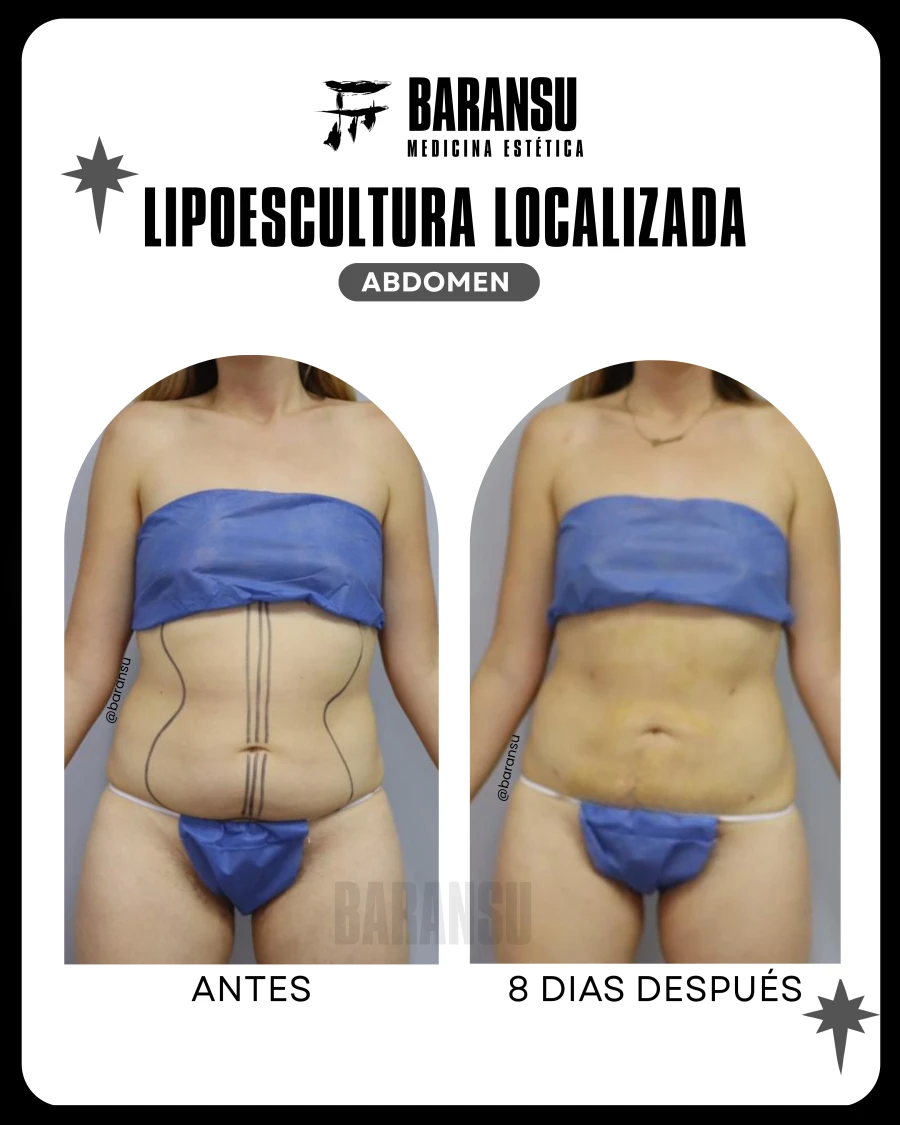 Lipoescultura Localizada (Minilipo) 45