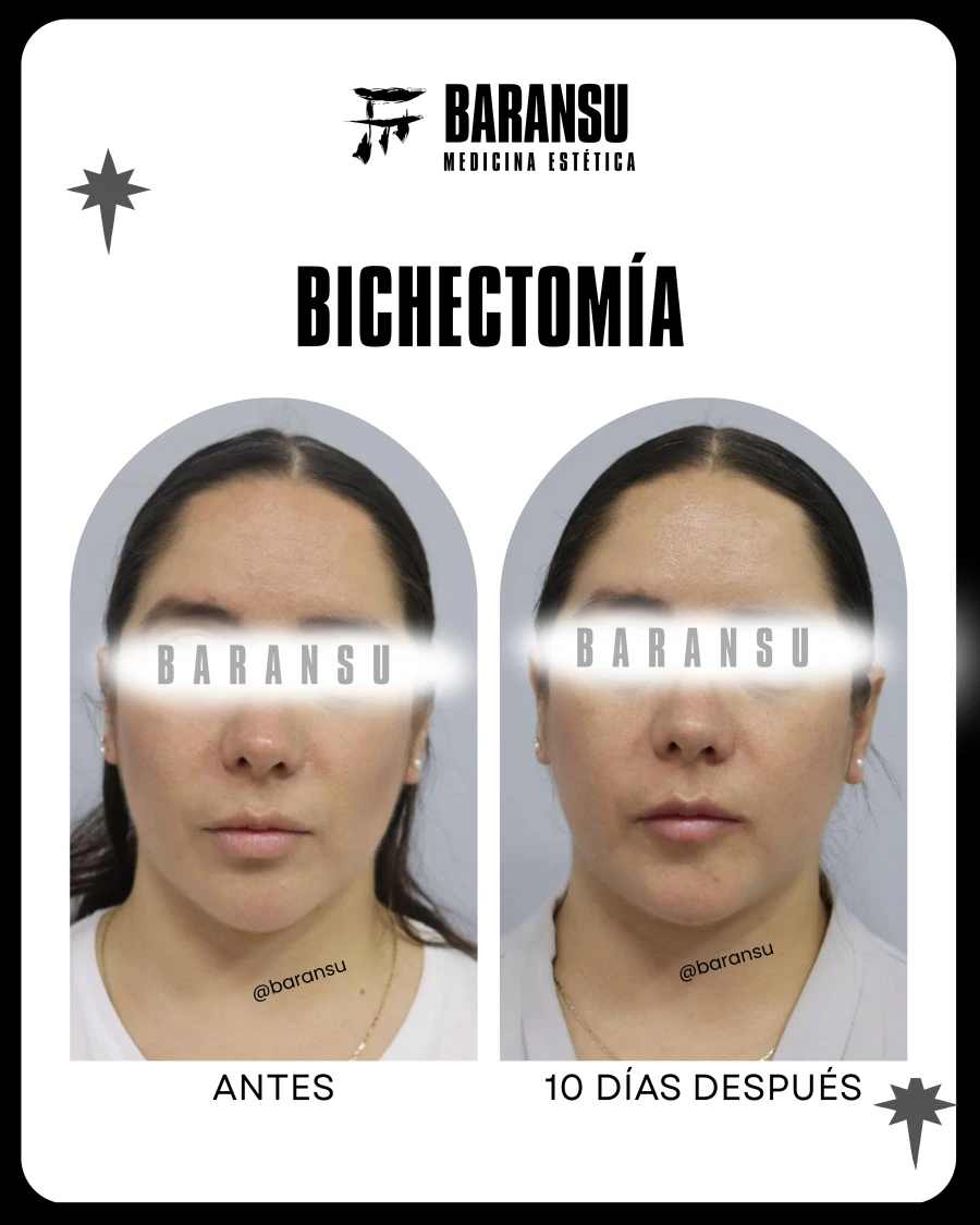 Bichectomía 29