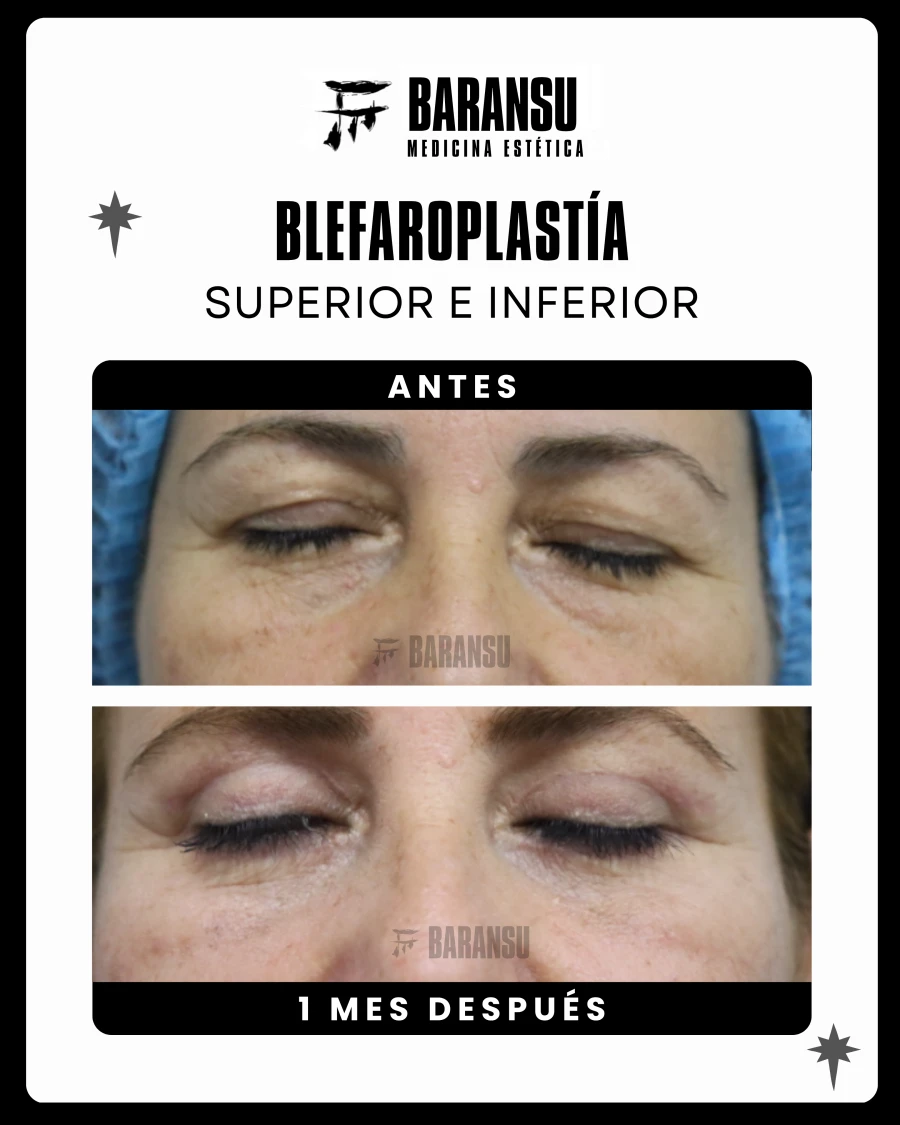 Blefaroplastía Superior e Inferior 5