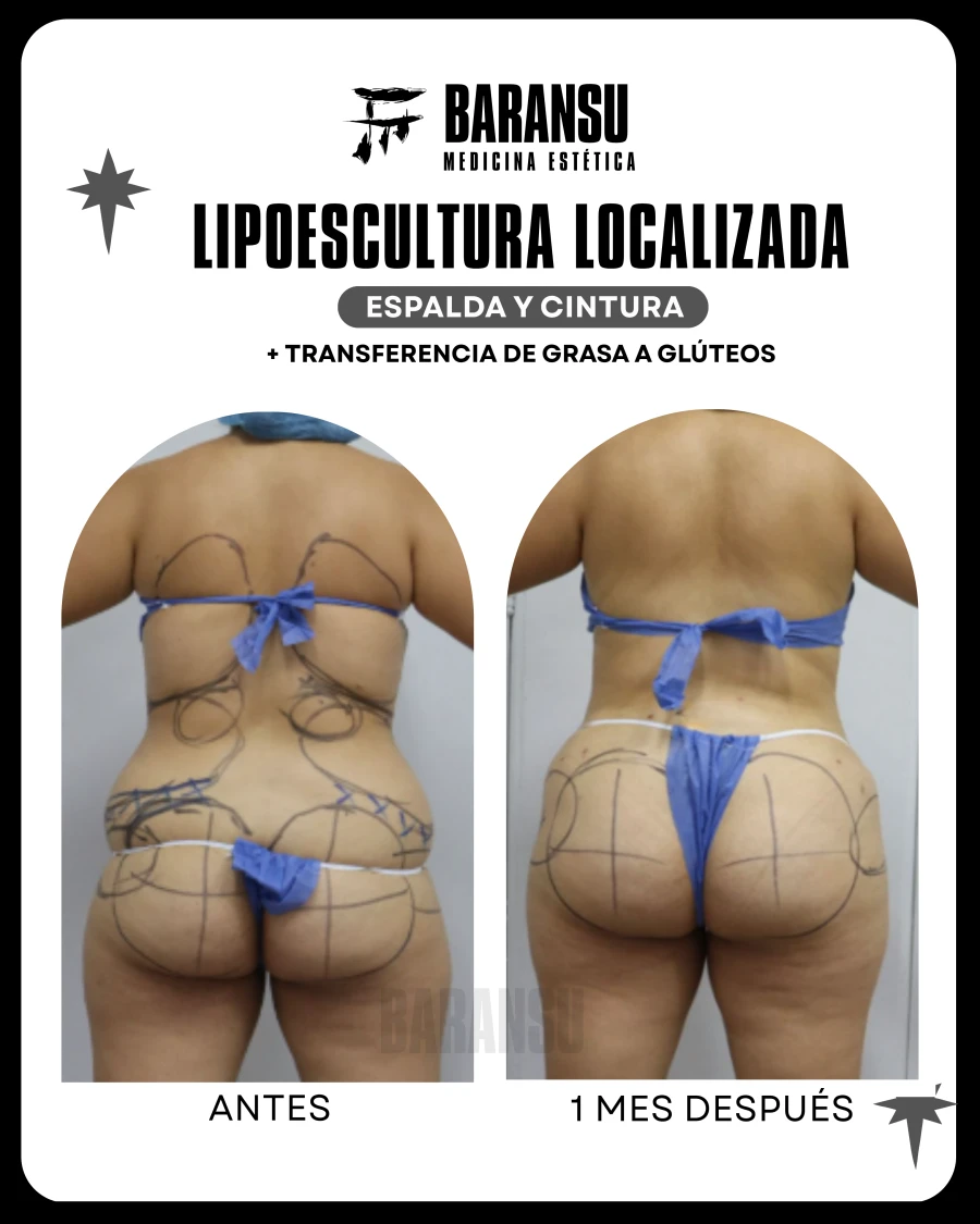 Lipoescultura Localizada (Minilipo) 29