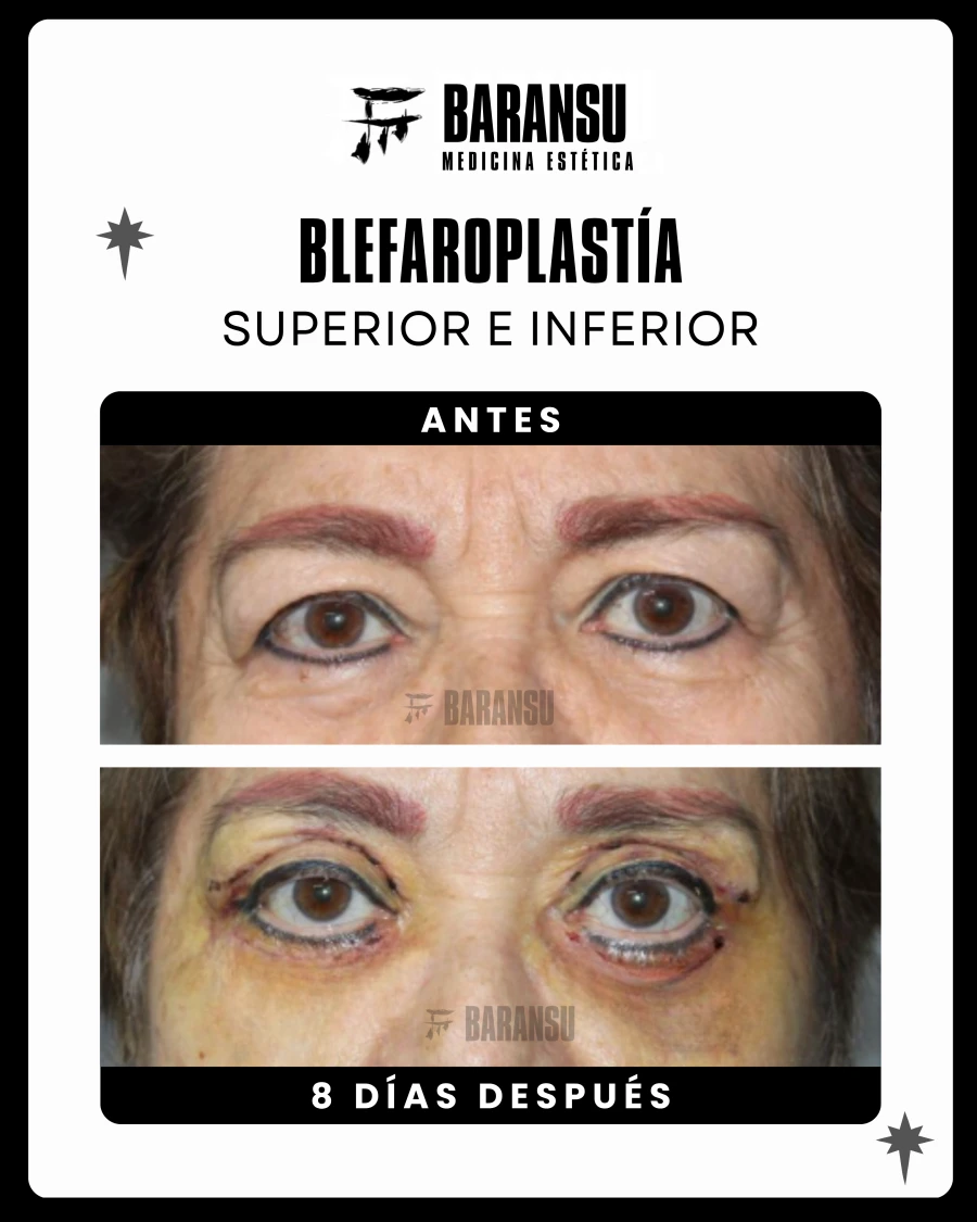 Blefaroplastía Superior e Inferior
