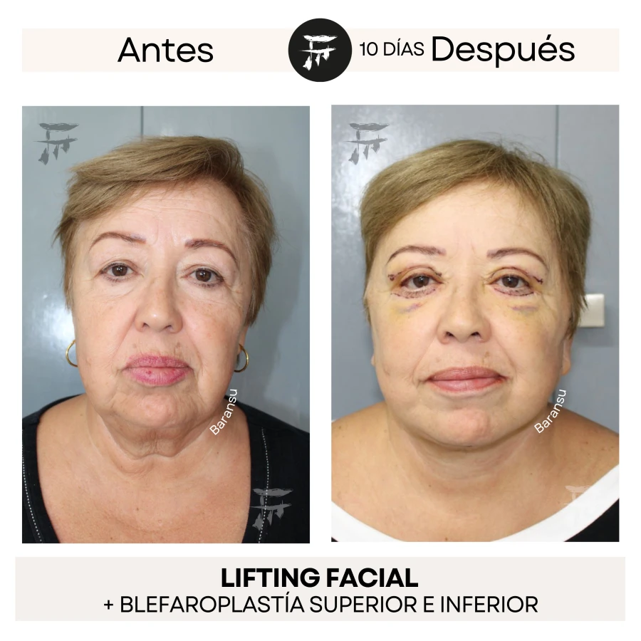 Lifting Facial + Blefaroplastía Superior e Inferior