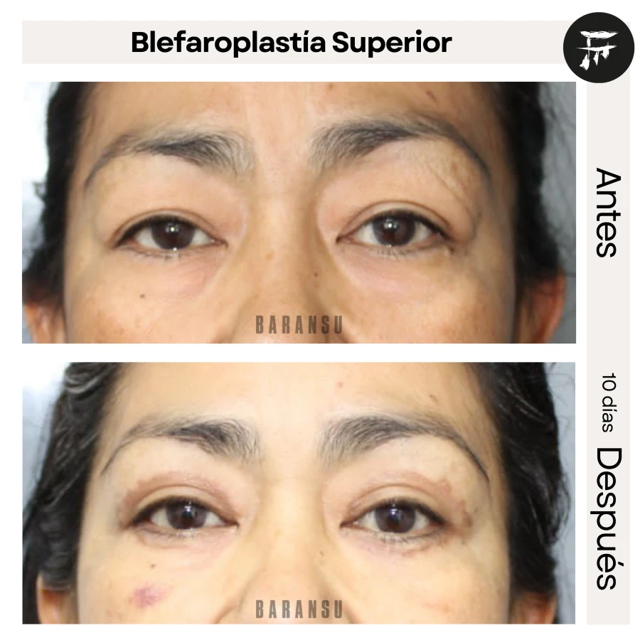 Blefaroplastía Superior