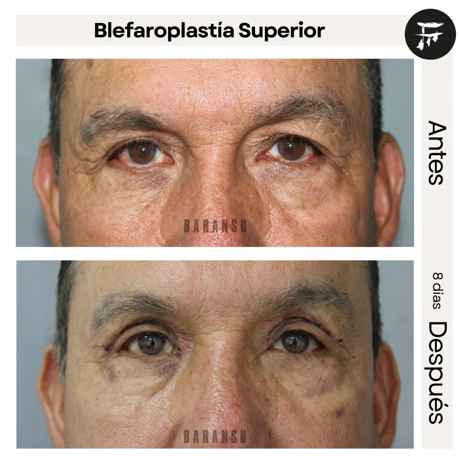 Blefaroplastía Superior
