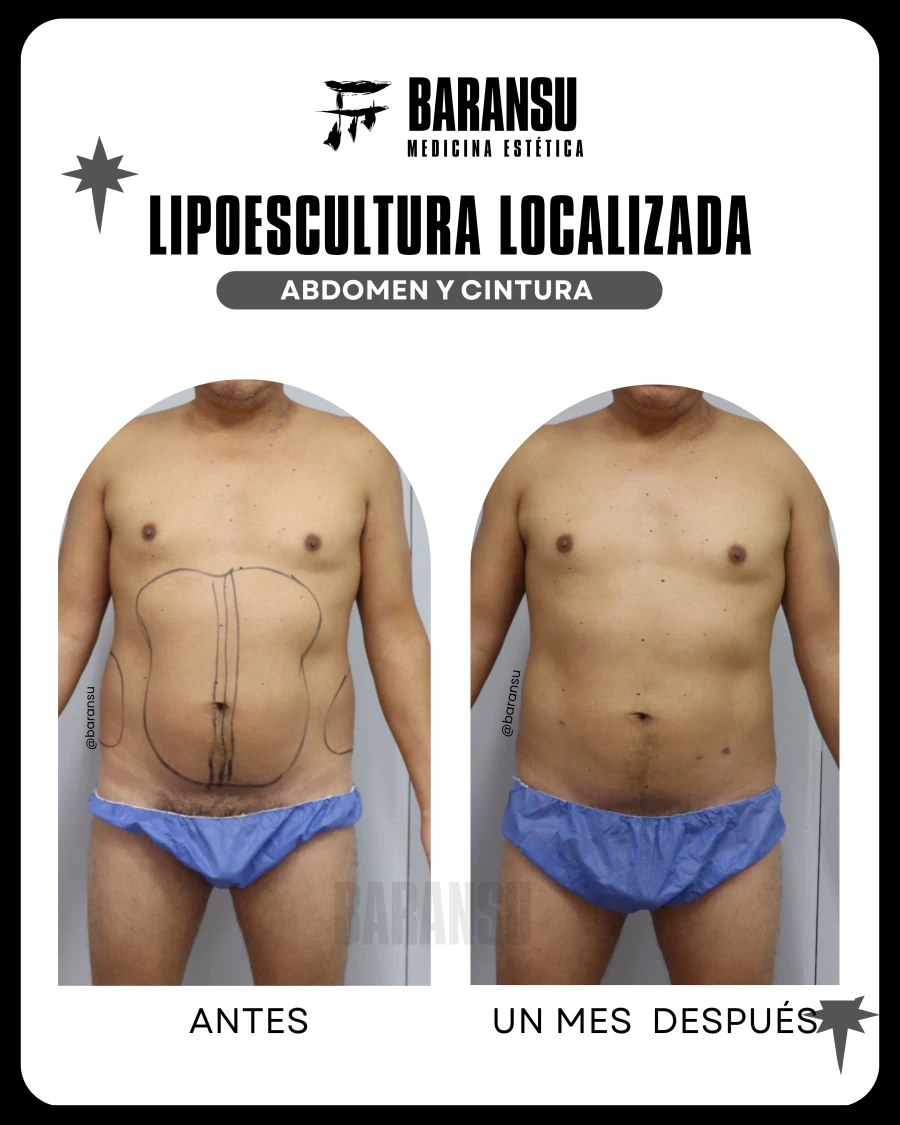 Lipoescultura Localizada (Minilipo) 48