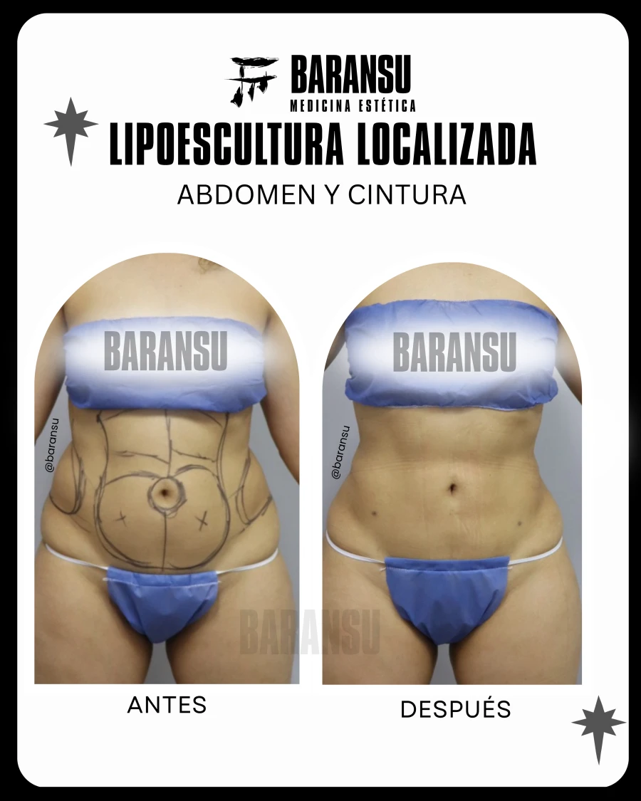 Lipoescultura Localizada (Minilipo) 10