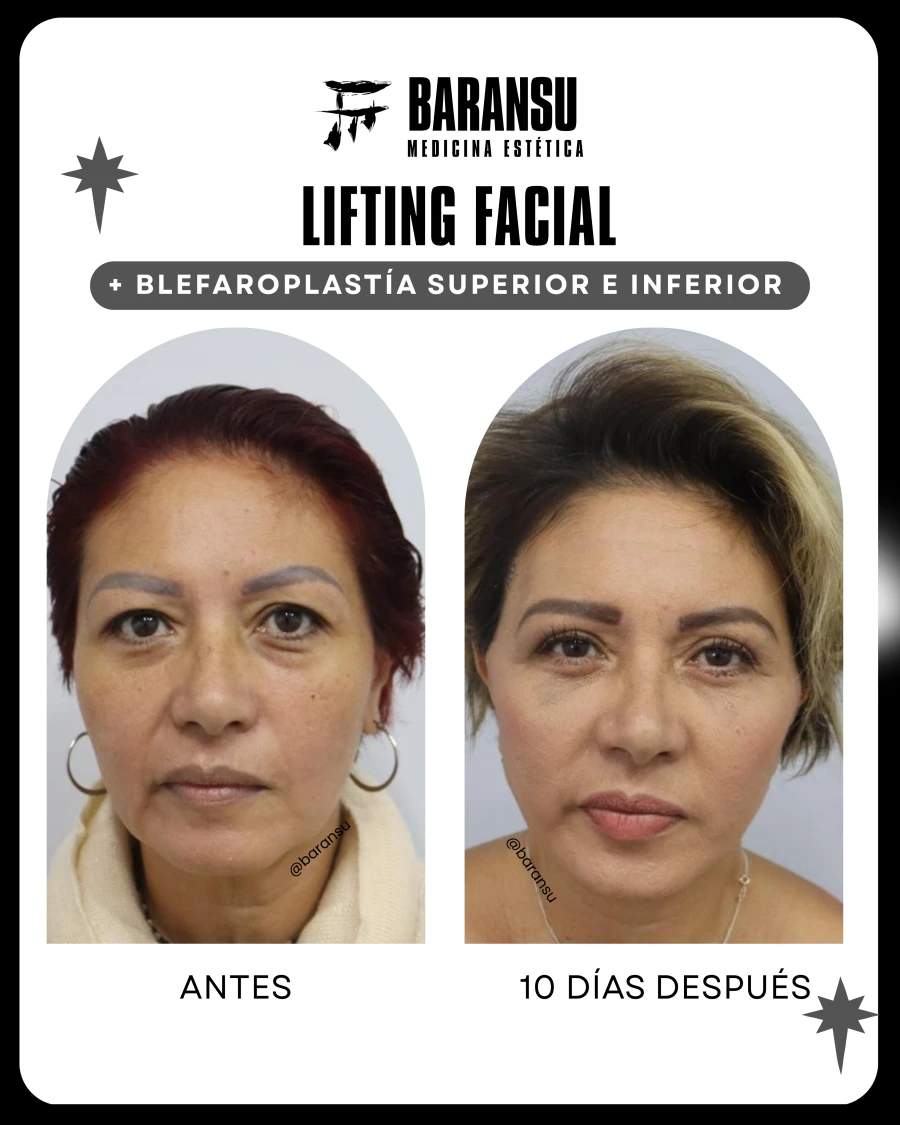 Lifting Facial + Blefaroplastía Superior e Inferior 9