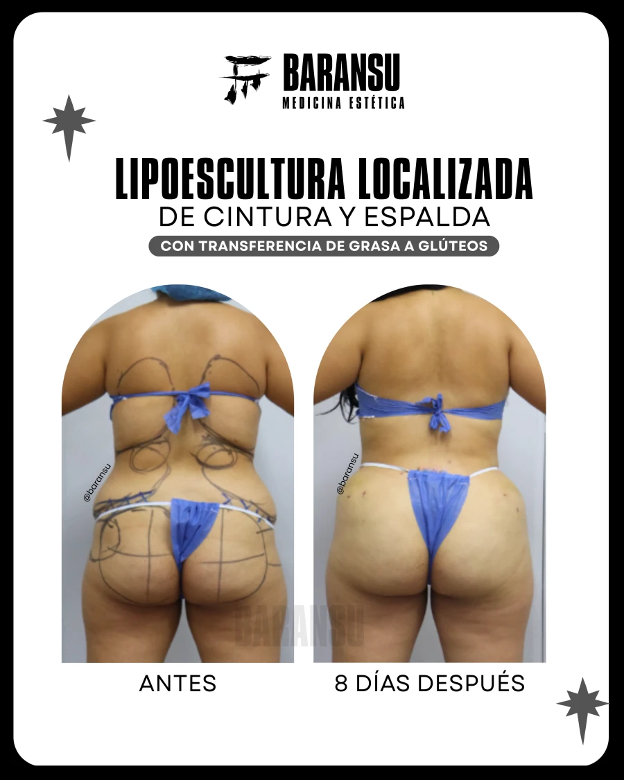 Lipoescultura Localizada (Minilipo) 34