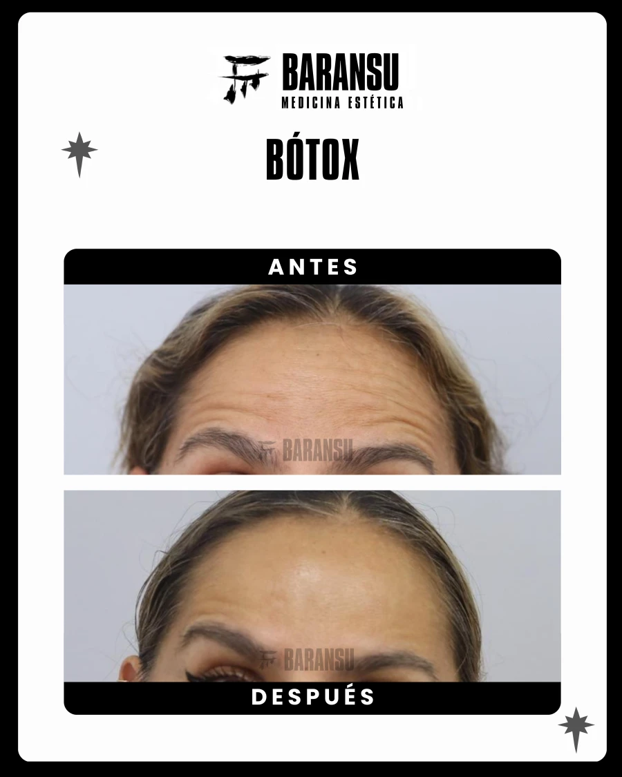 Bótox 0
