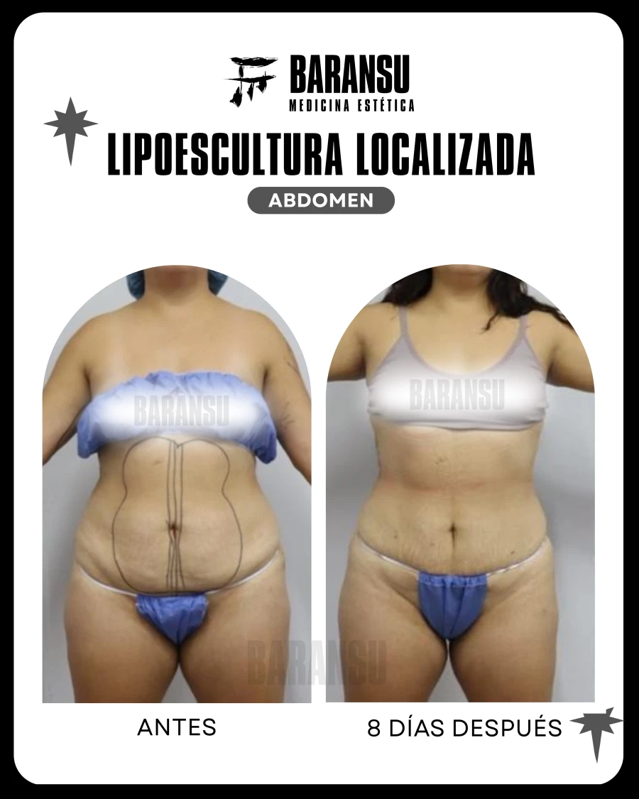 Lipoescultura Localizada (Minilipo) 30