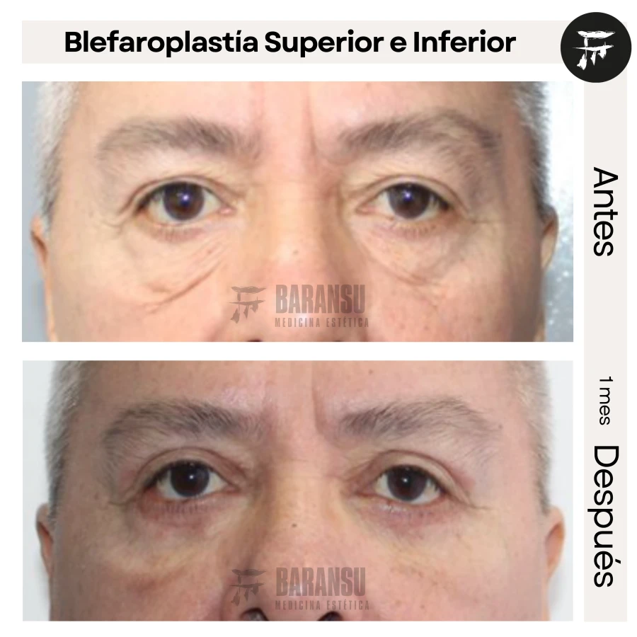 Blefaroplastía Superior e Inferior