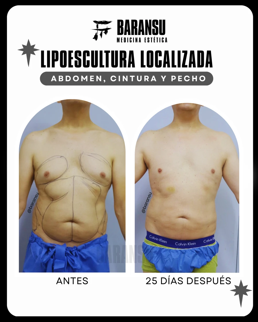 Lipoescultura Localizada (Minilipo) 12