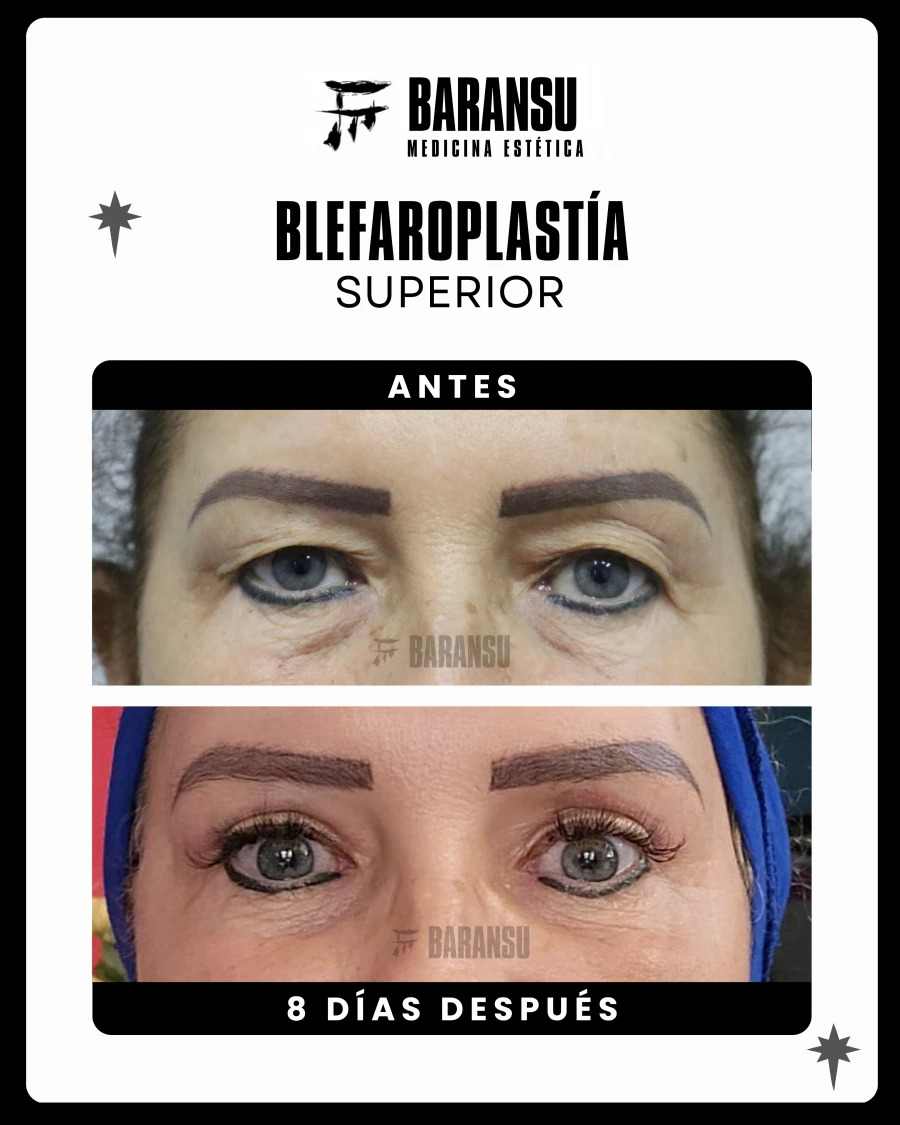 Blefaroplastía Superior