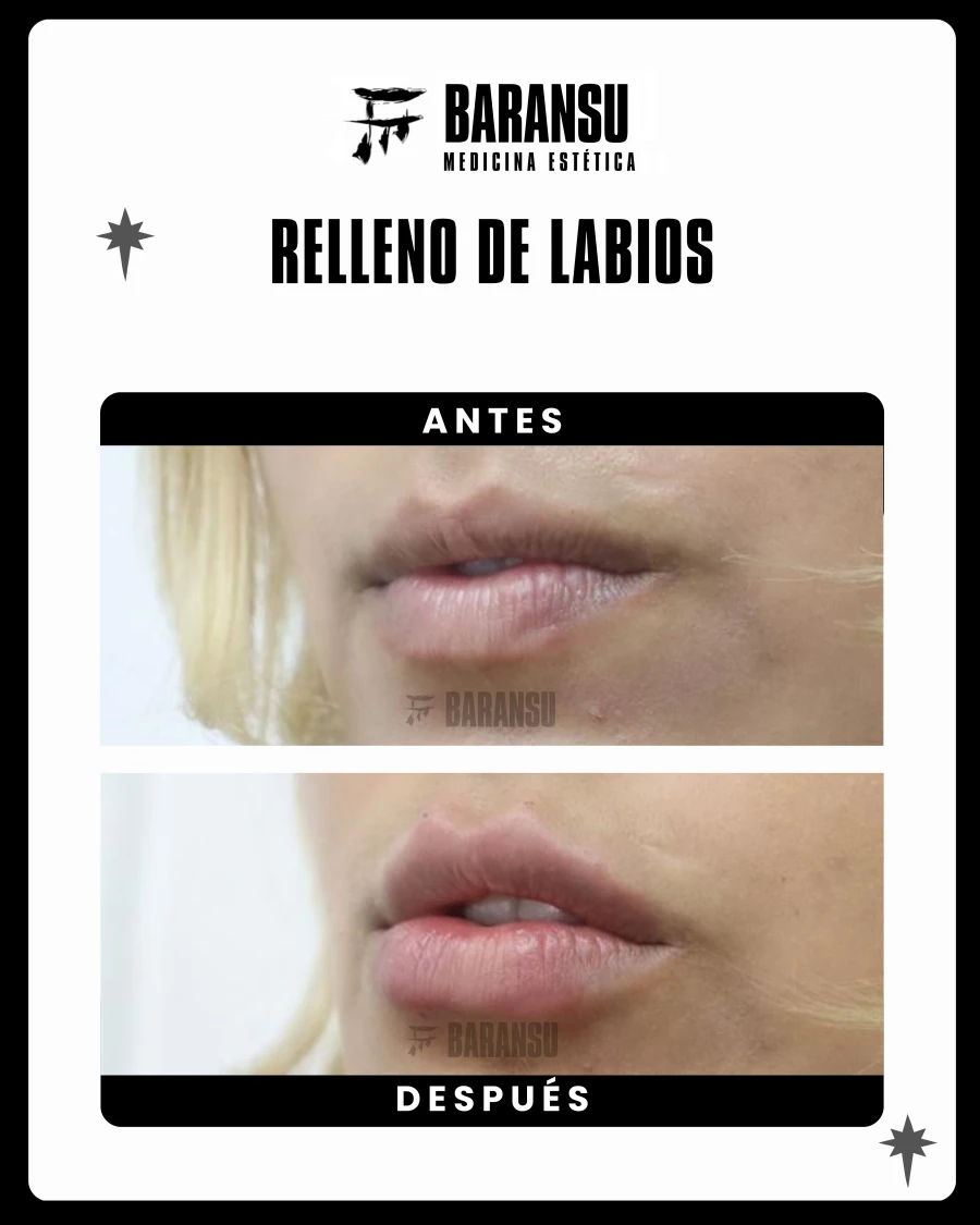Relleno de Labios