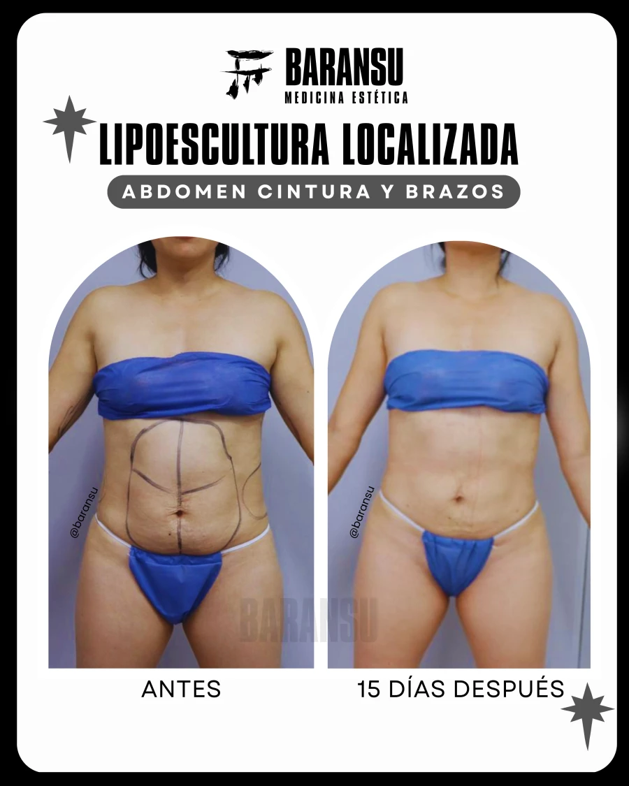Lipoescultura Localizada (Minilipo) 20