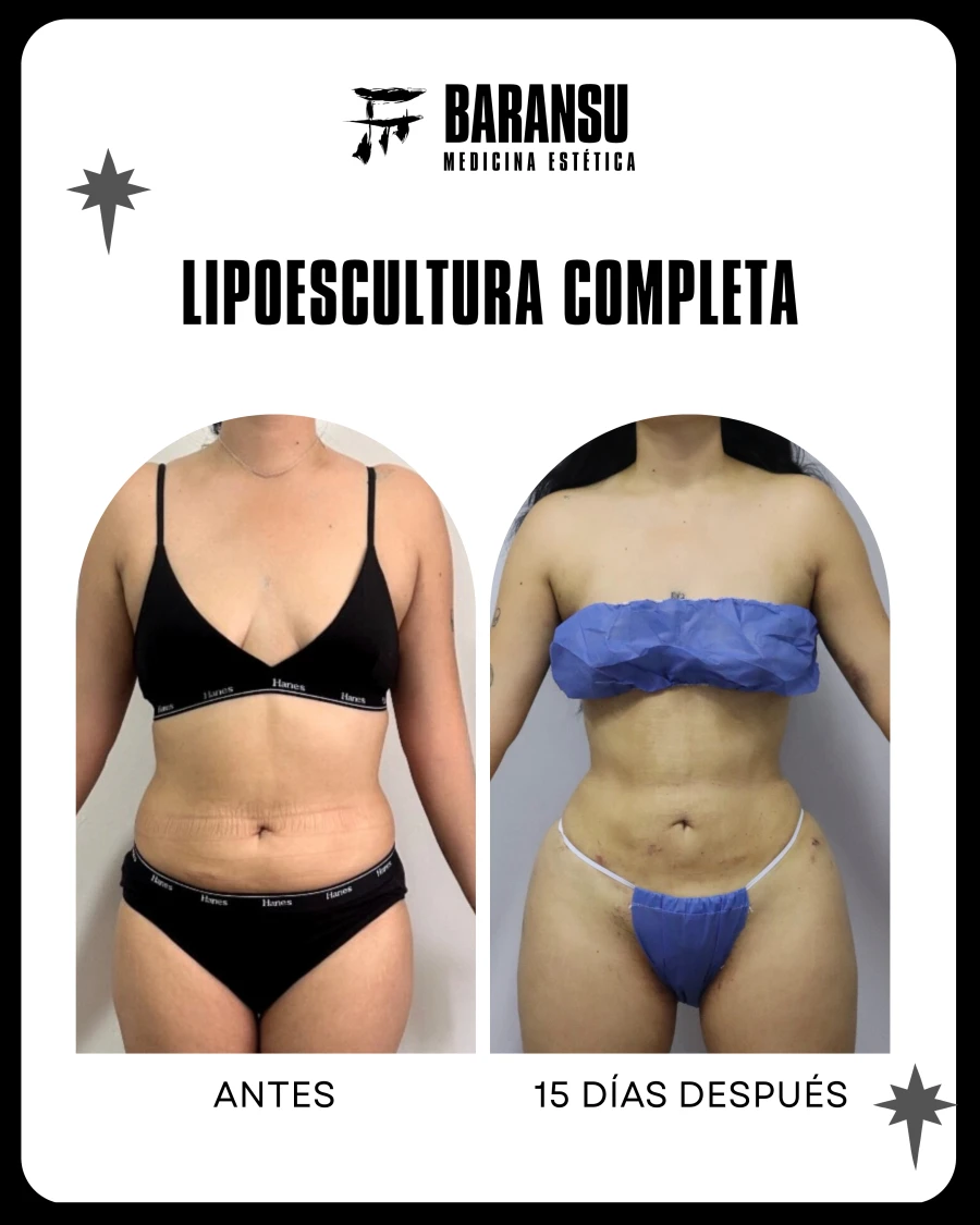 Lipoescultura Localizada (Minilipo) 26