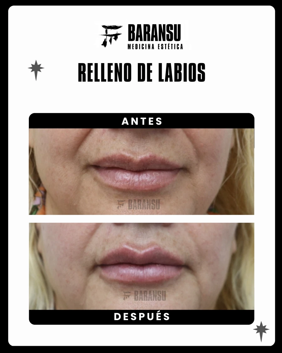 Relleno de Labios 6