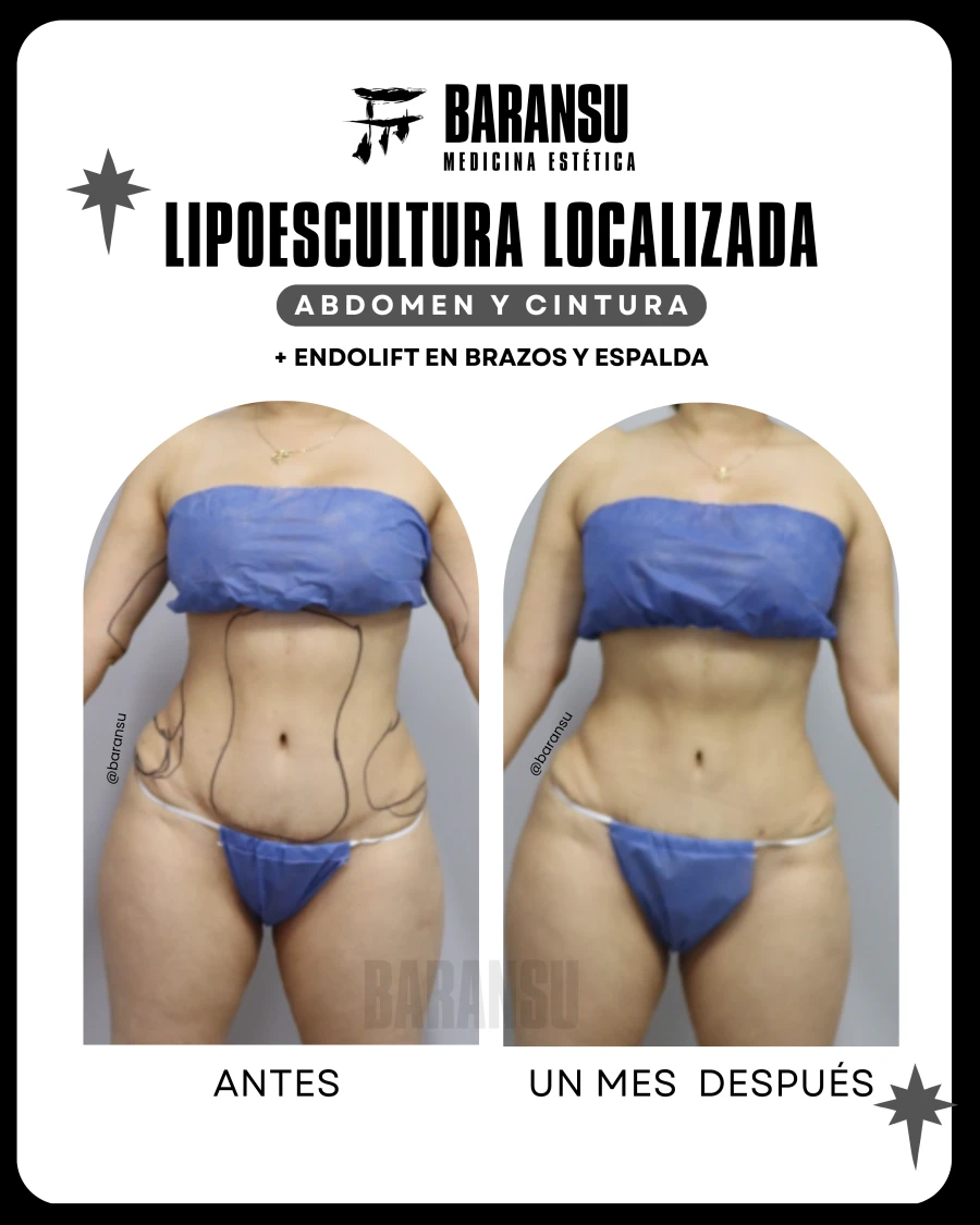 Lipoescultura Localizada (Minilipo) 49