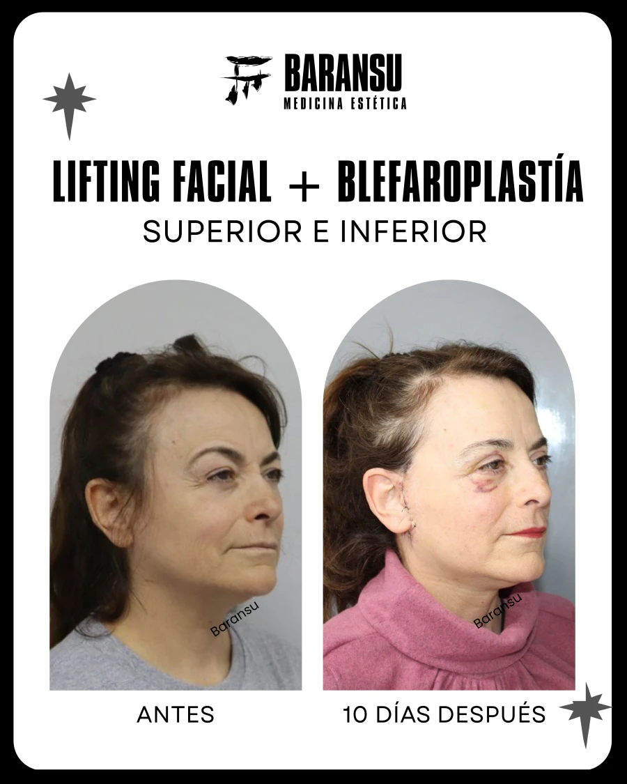 Lifting Facial + Blefaroplastía Superior e Inferior 