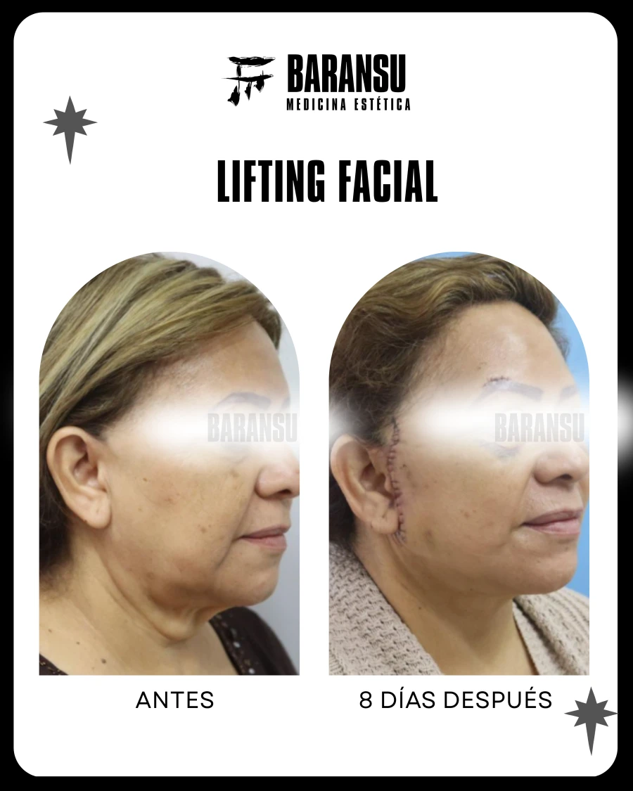 Lifting Facial 6