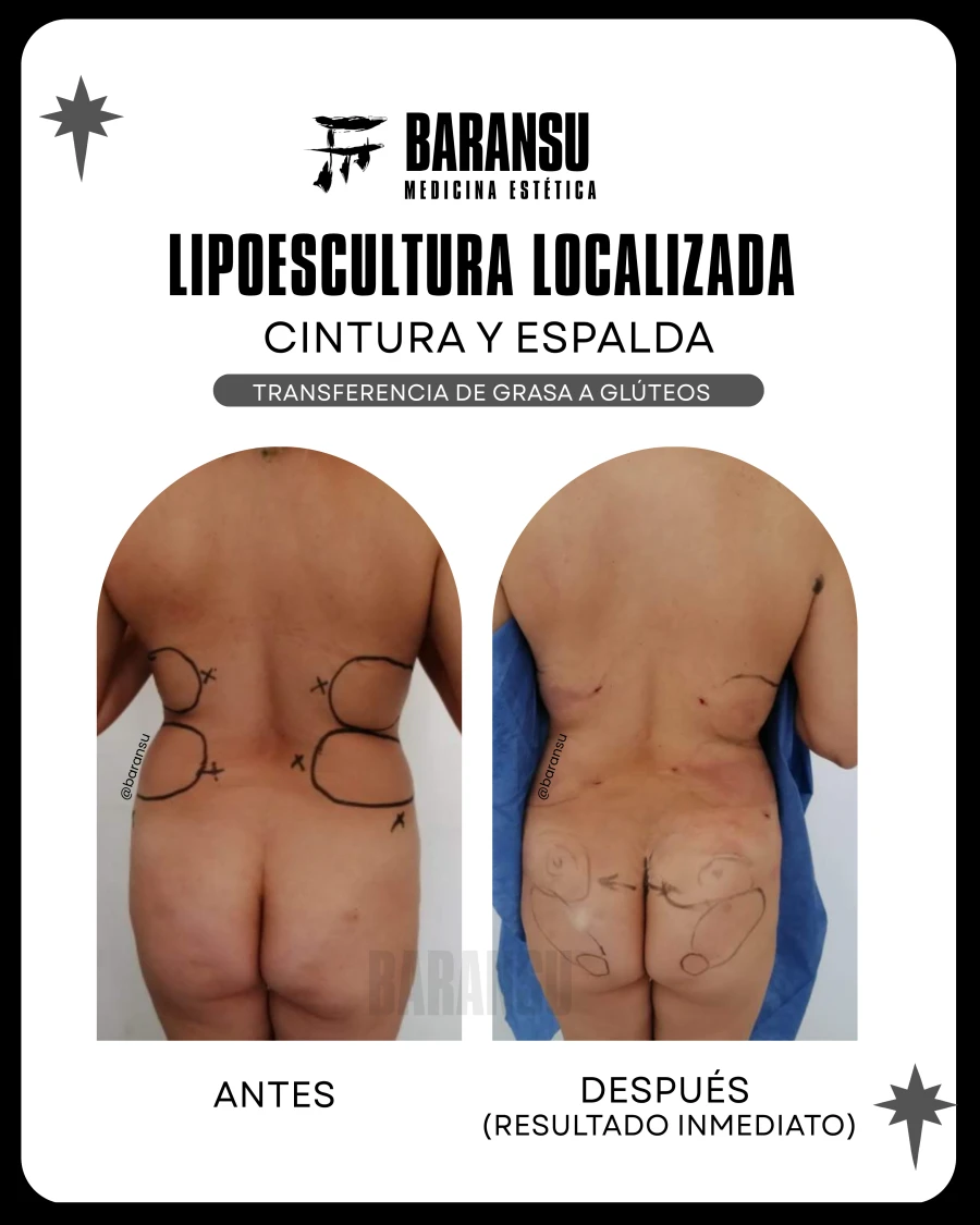 Lipoescultura Localizada (Minilipo) 23