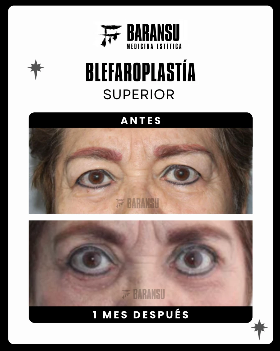 Blefaroplastía Superior
