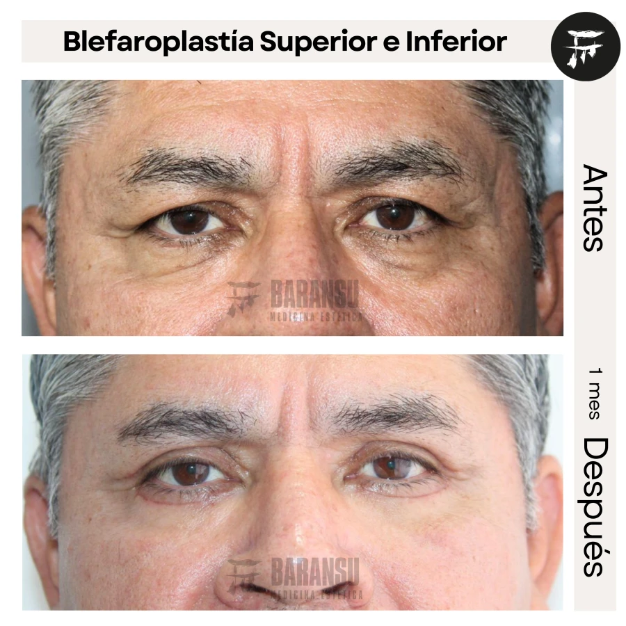 Blefaroplastía Superior e Inferior