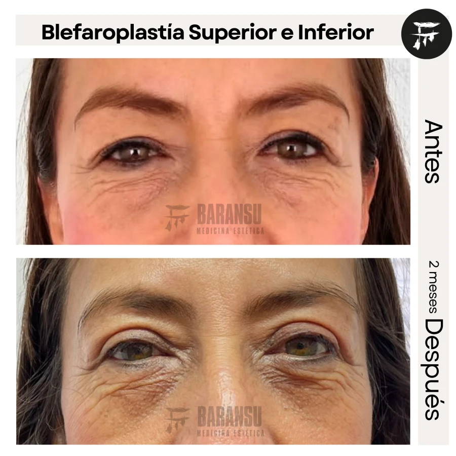 Blefaroplastía Superior e Inferior
